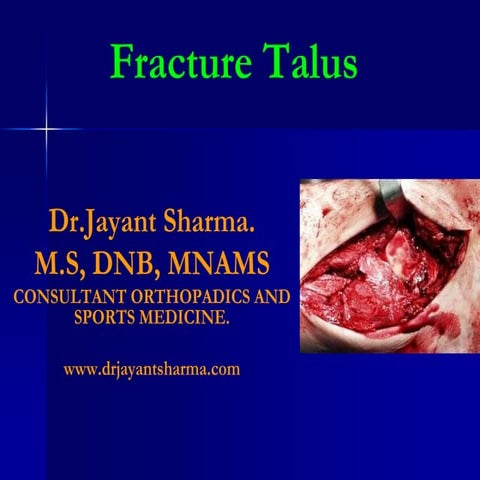 Talar fractures2