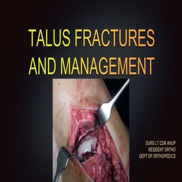 Talus fractures and mx