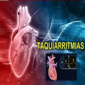 Tipos de Taquiarritmias
