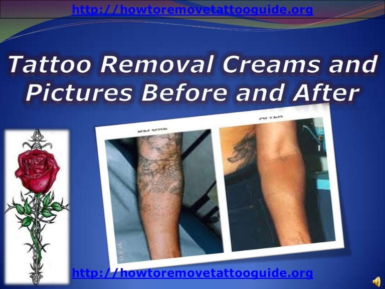Tattoo removal creams and pictures before and after