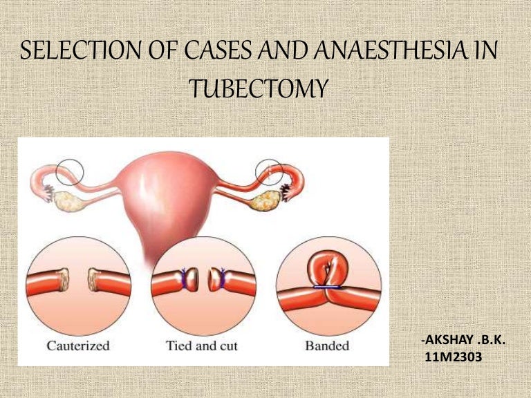 SELECTION OF CASES AND ANAESTHESIA IN TUBECTOMY