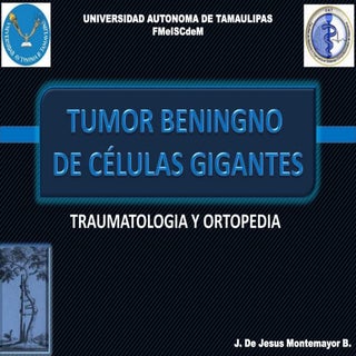 Tumor Benigno de Celulas Gigantes /...