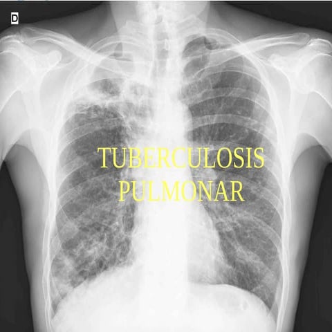 tuberculosis pulmonar