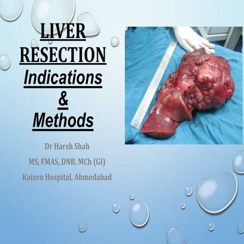Liver resection   indications &amp; methods