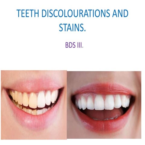Teeth stains and discolorations