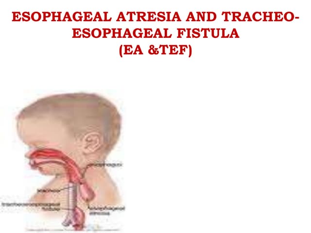 Tracheo oesophageal fistula | PPTX
