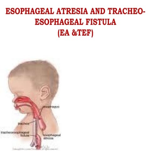 TRACHEOESOPHAGEAL FISTULA | PPTX