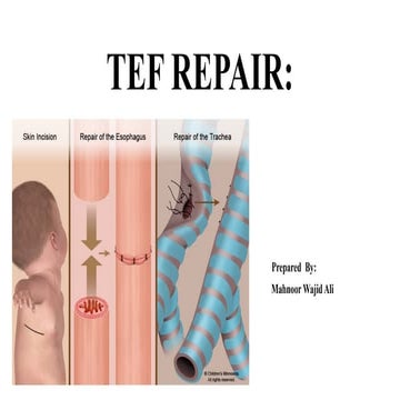 Tracheoesophageal fistula repair REPAIR.pptx