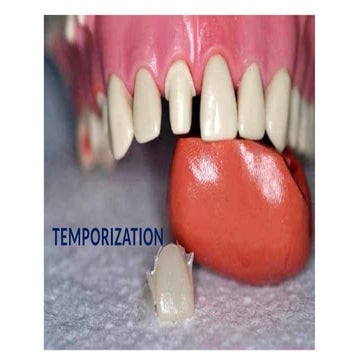 Temporization in fixed partial dentures and its importance | PPTX