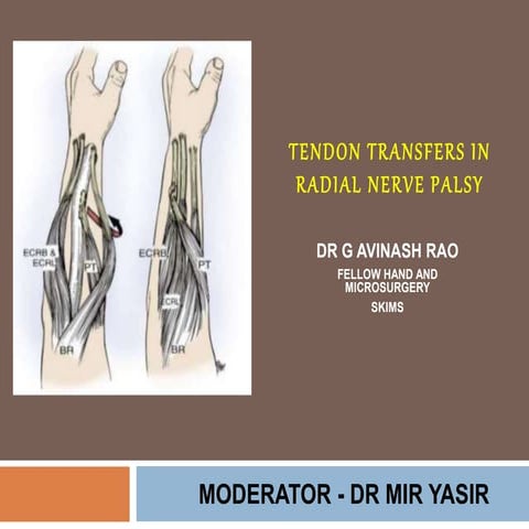 Tendon transfers for radial nerve palsy