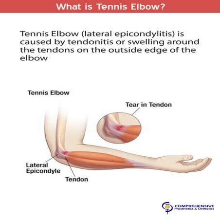 Tennis elbow