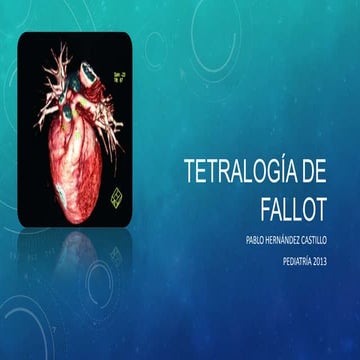 Tetralogía de Fallot