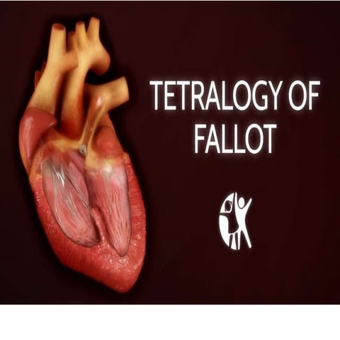 Tetralogy of fallot