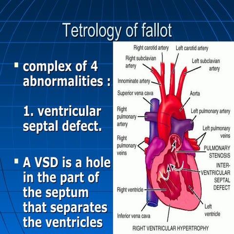 Tetrology of fallot