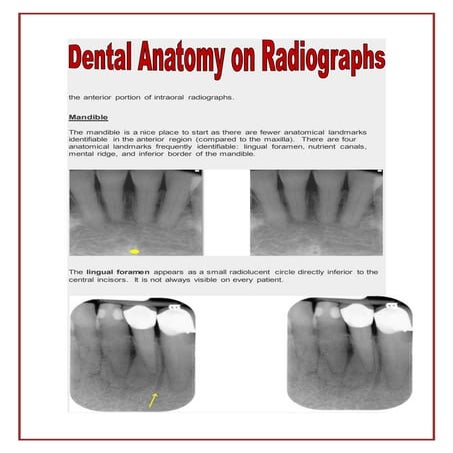 The anterior portion of intraoral radiographs
