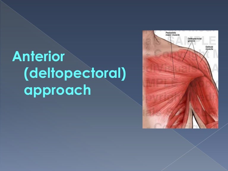 The deltopectoral approach