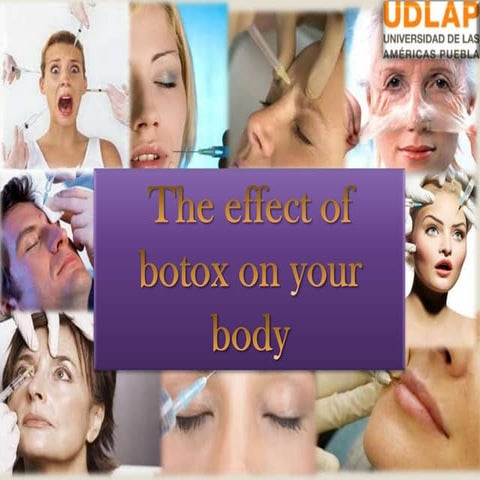 The Beauty of BOTOX | PPTX