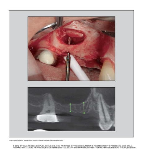 The effect of cigarette smoking and native bone heigth