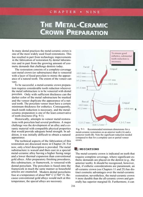 Try in and cementation of crown | PPT