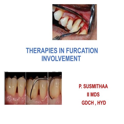 PPT - TREATMENT IN FURCATION INVOLVEMENT.pptx