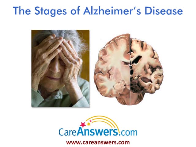 The Stages of Alzheimer’s Disease