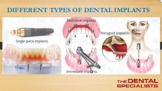 The Top Types of Dental Implants You Need to Know