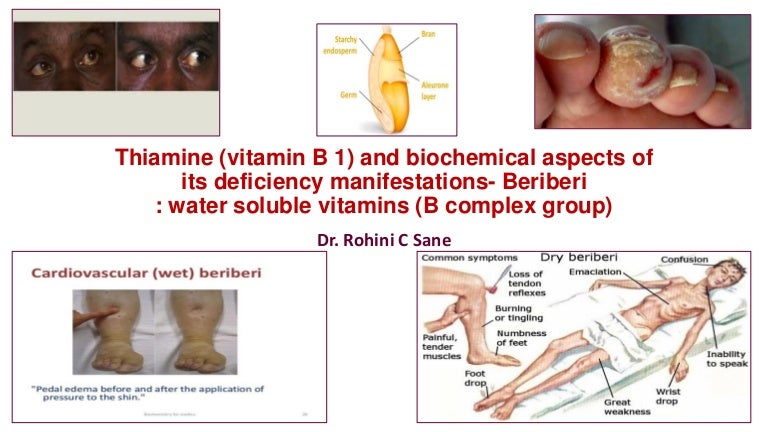 beriberi is caused due to deficiency of vitamin beriberi is caused due to deficiency of vitamin