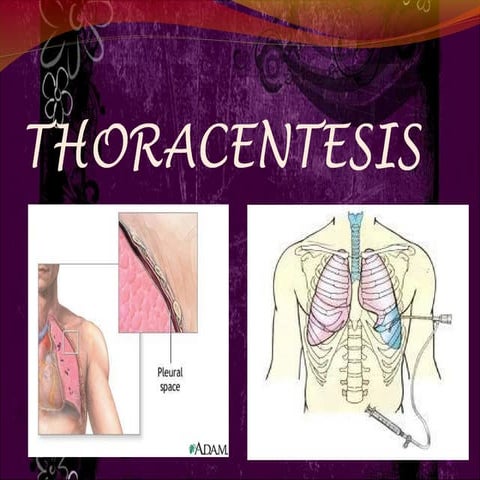 thoracentesis2-121023054532-phpapp02.pdf