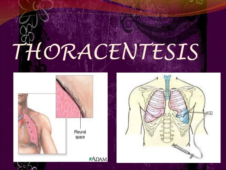 Thoracentesis
