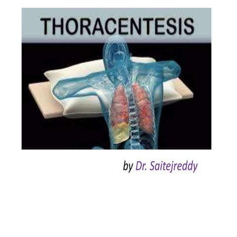 Thoracocentesis