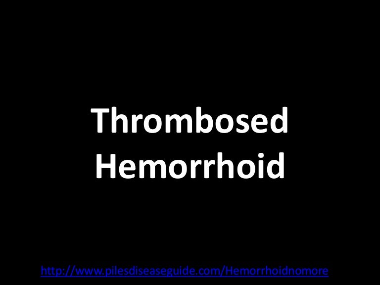 Thrombosed hemorrhoid