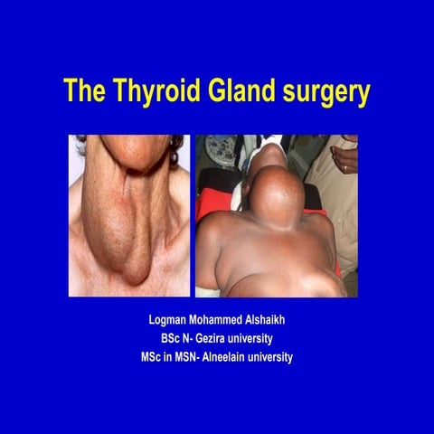 Thyroidectomy 