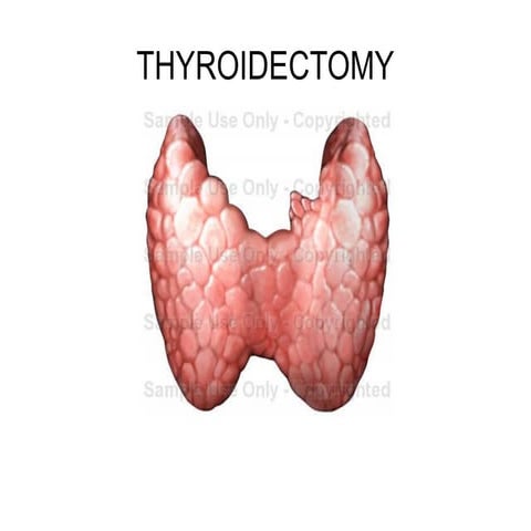 Thyroidectomy 