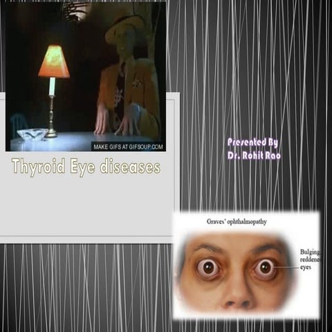Thyroid eye diseases   