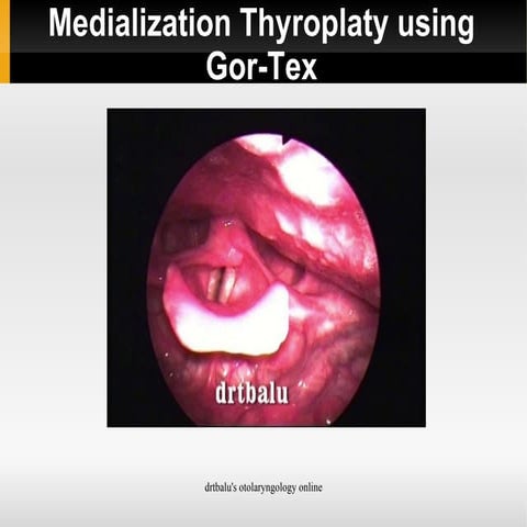 Thyroplasty