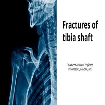 Tibia Fracture classification and management | PPTX