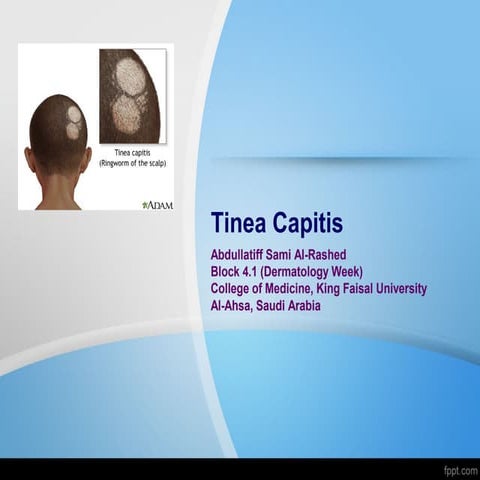 Tinea Capitis