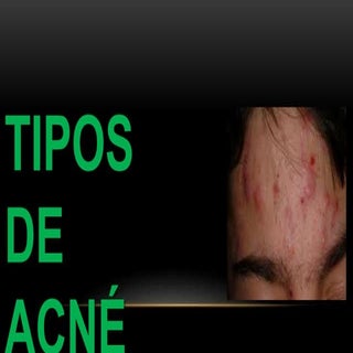 Tipos de acne