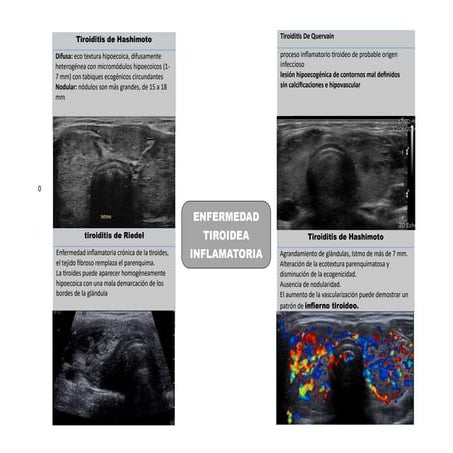 Tiroiditis de Hashimoto tarea dr henry avance.pdf