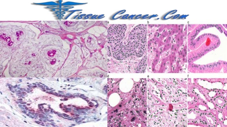 What Causes Angiosarcoma Cancer – DSXE