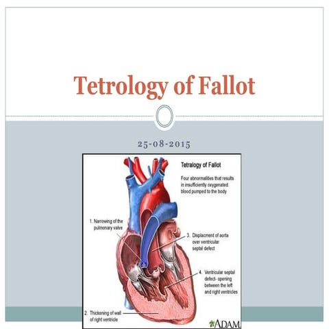Tetrology of Fallot (TOF) - A Review