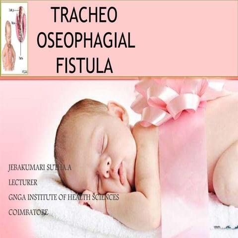 tracheo oesophagal fistula   gihs
