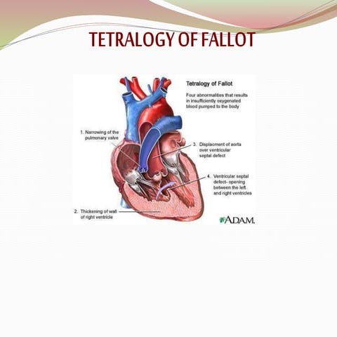 tertalogy of fallot