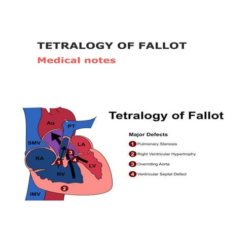 Medical notes on tetralogy of fallot(TOF)