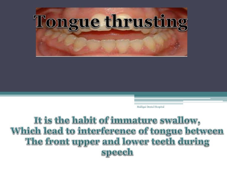 Tongue thrusting habit clinical