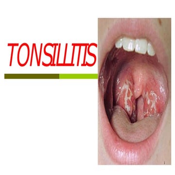 TONSILITIS.pptx