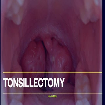 Tonsillectomy: Surgical Removal of Tonsils | PDF