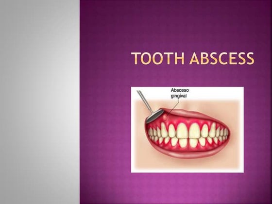 Indications for the Root Canal Treatment | PPT
