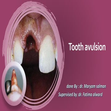 Tooth avulsion dr.maryam salman | PPTX