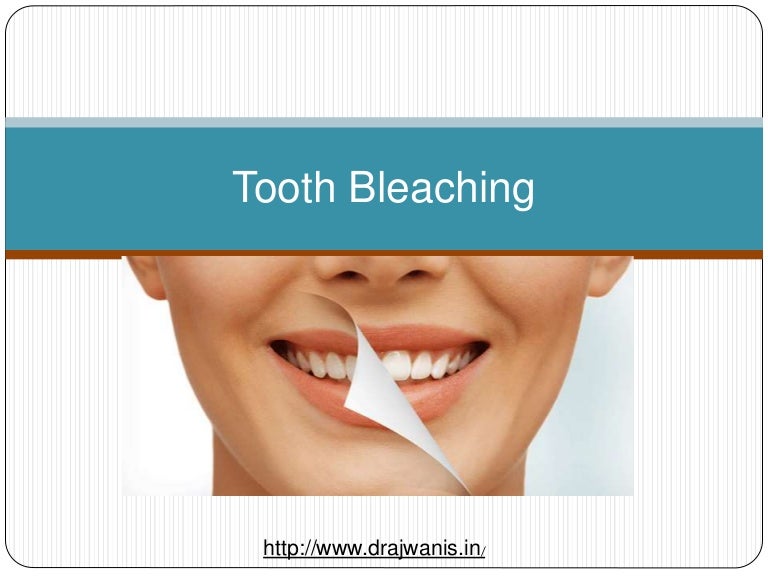 Overview of Tooth Bleaching by Pune’s Best Dentist Dr Ajwani